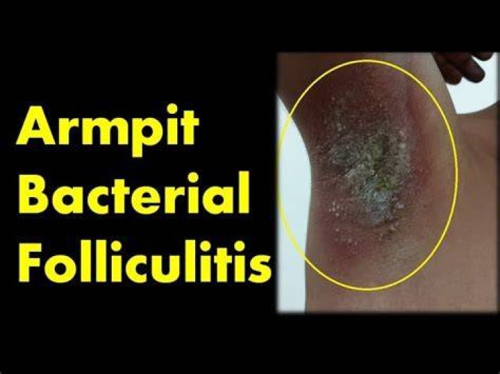 armpit folliculitis
