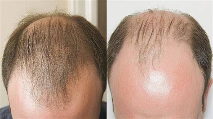 Can you reverse baldness