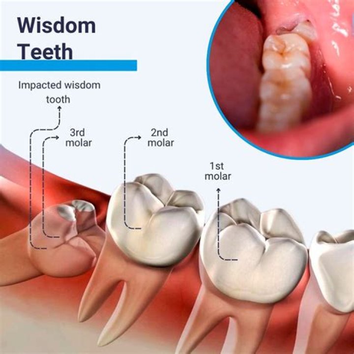 Does everyone have wisdom teeth?