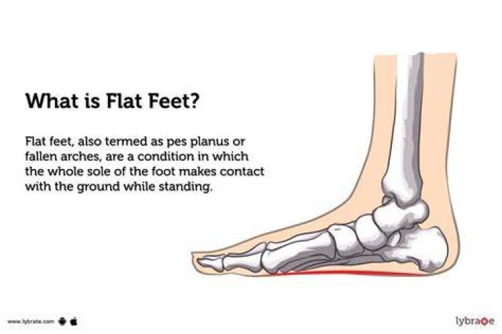 flat footed meaning