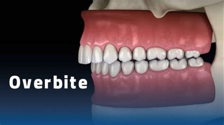 Is Having An Overbite Bad