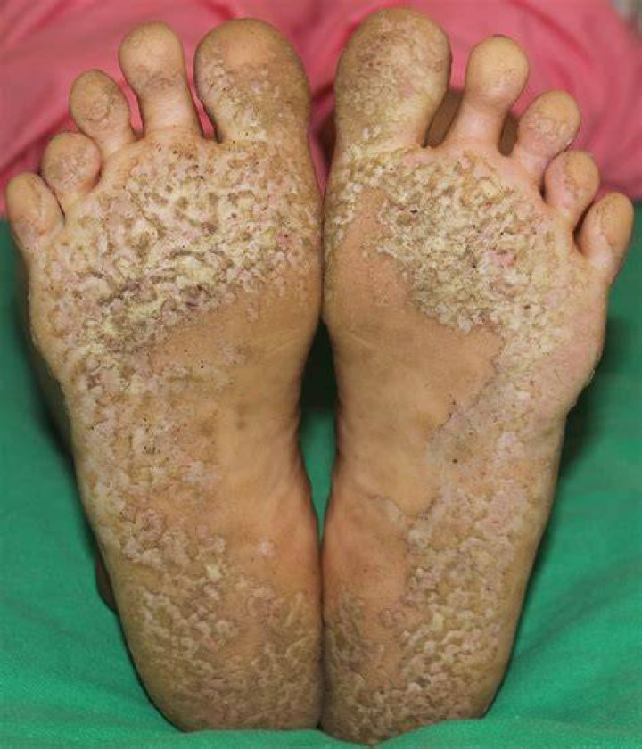 pitted skin