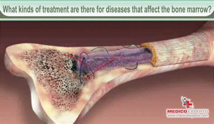 What is bone marrow damage